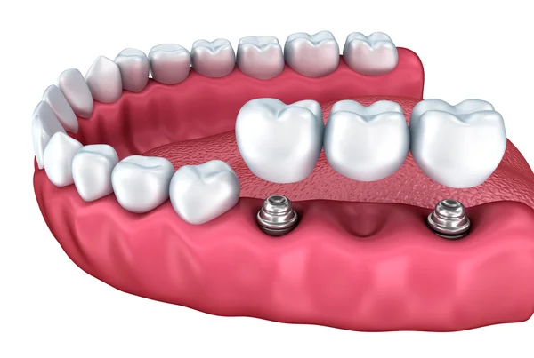 Implantes dentales Alcorcón Madrid - Corona sobre implante