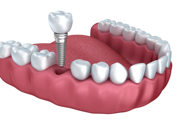 Implantes dentales Alcorcón Madrid - Implante